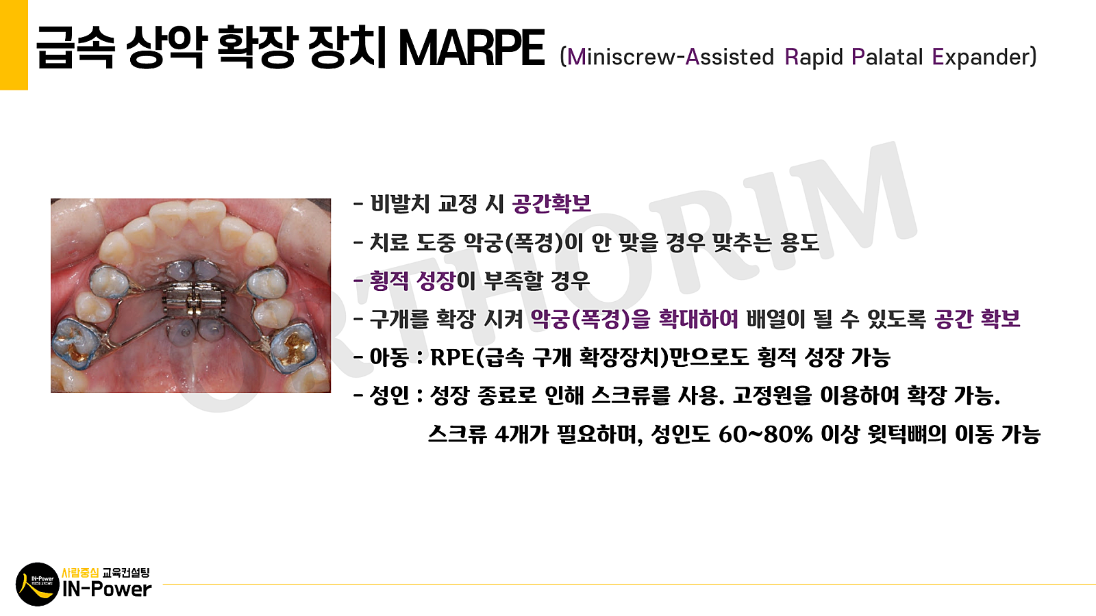 [치아교정] 급속상악확대(RME)의 모든 것 - 교정임상스페셜리스트 Q&A : 네이버 블로그
