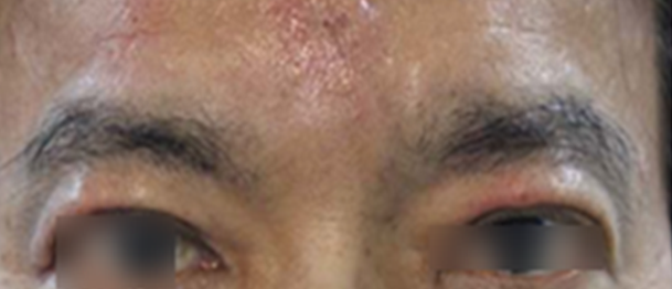 미간주름 영구교정술 체험지원 안내 : 네이버 블로그